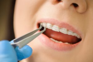 Clínica dental en Rocafort - brackets de zafiro