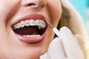 ortodoncia en Burjasot - limpieza