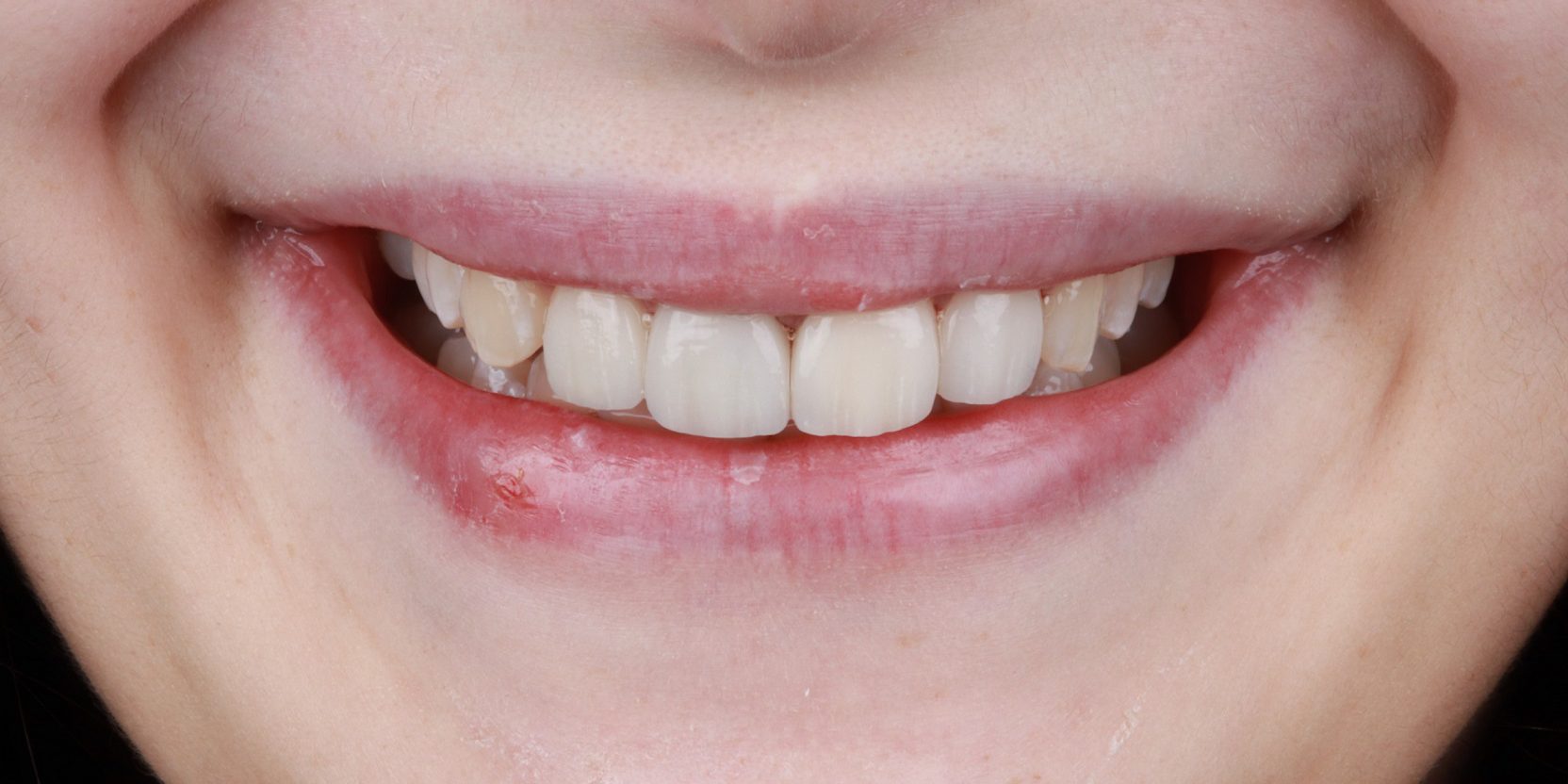 implantes dentales en Burjassot – sonrisa implantes dentales en Burjassot - sonrisa