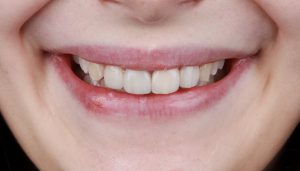 implantes dentales en Burjassot - sonrisa