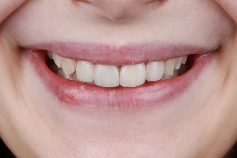 implantes dentales en Burjassot – sonrisa implantes dentales en Burjassot - sonrisa