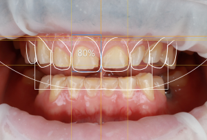 dentistas en Burjassot - simulación