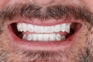 dentistas en Burjassot - mock up sonrisa