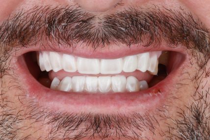 dentistas en Burjassot - mock up sonrisa