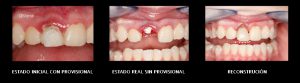 implantes dentales en Burjassot - reconstrucciÃ³n