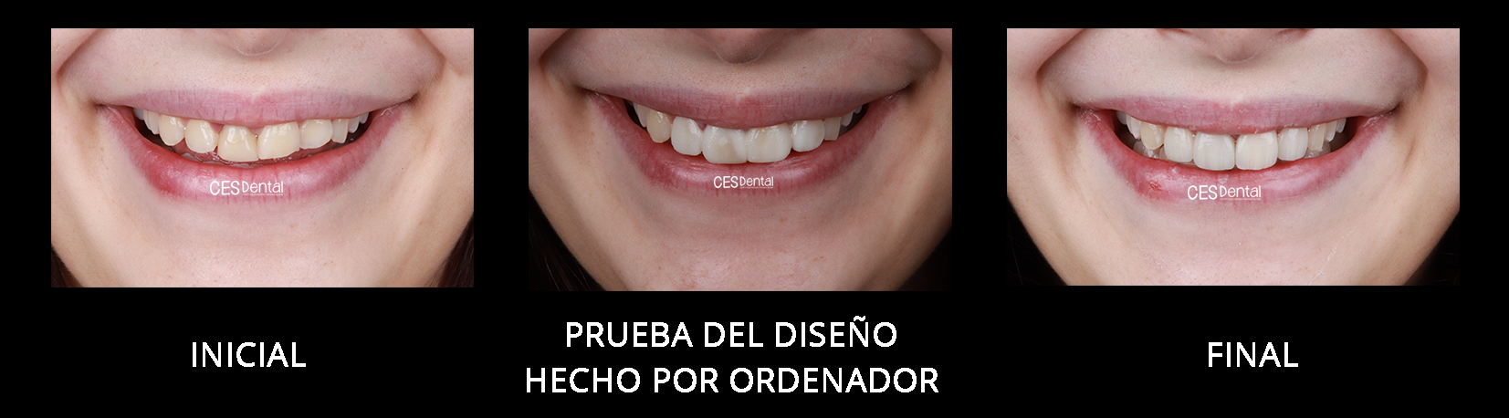 Dientes Postizos Temporal Sonrisa Dental Carilla Estetica - VERALY