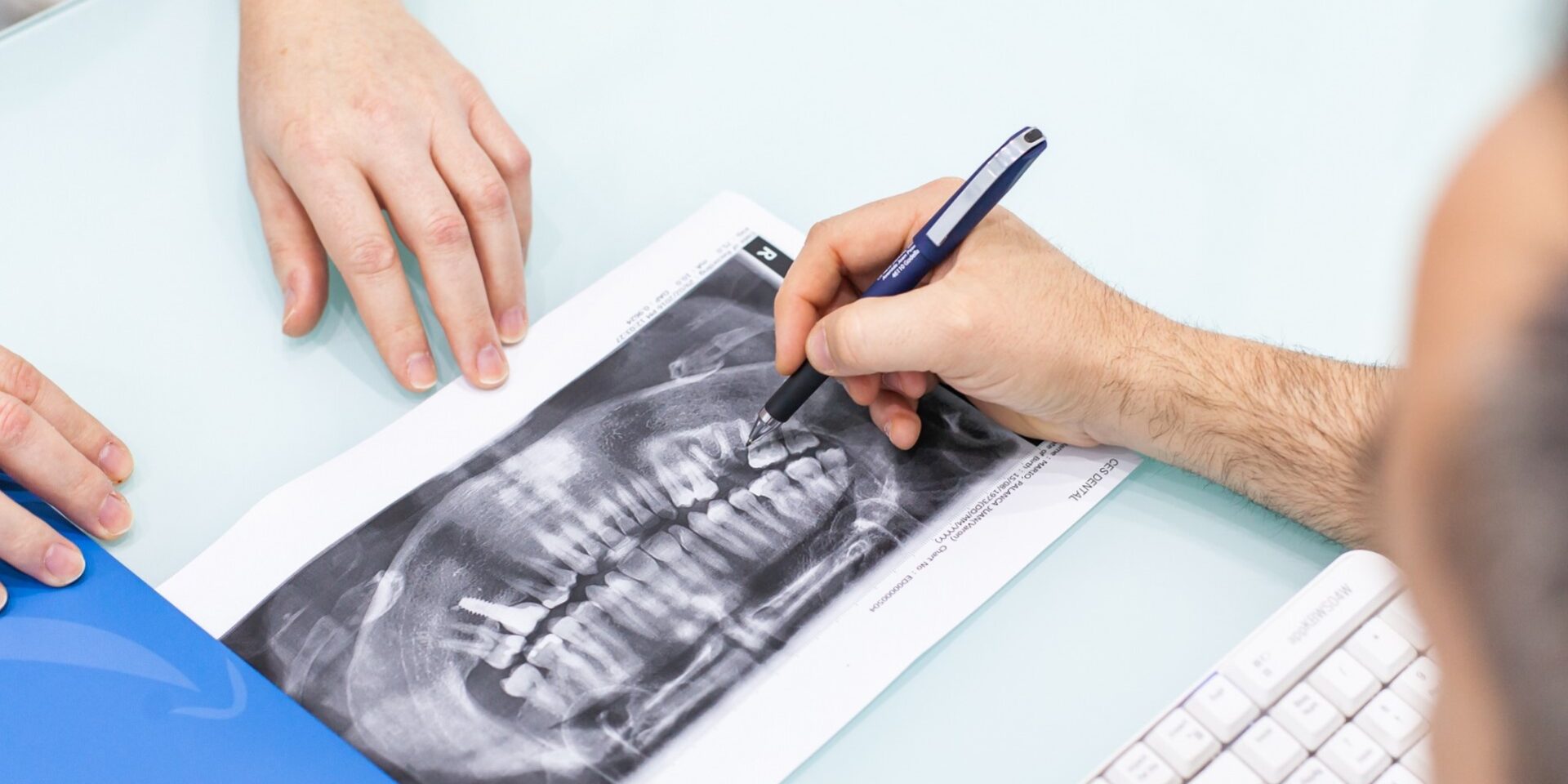 prótesis dentales en Burjassot – revisión prótesis dentales en Burjassot - revisión
