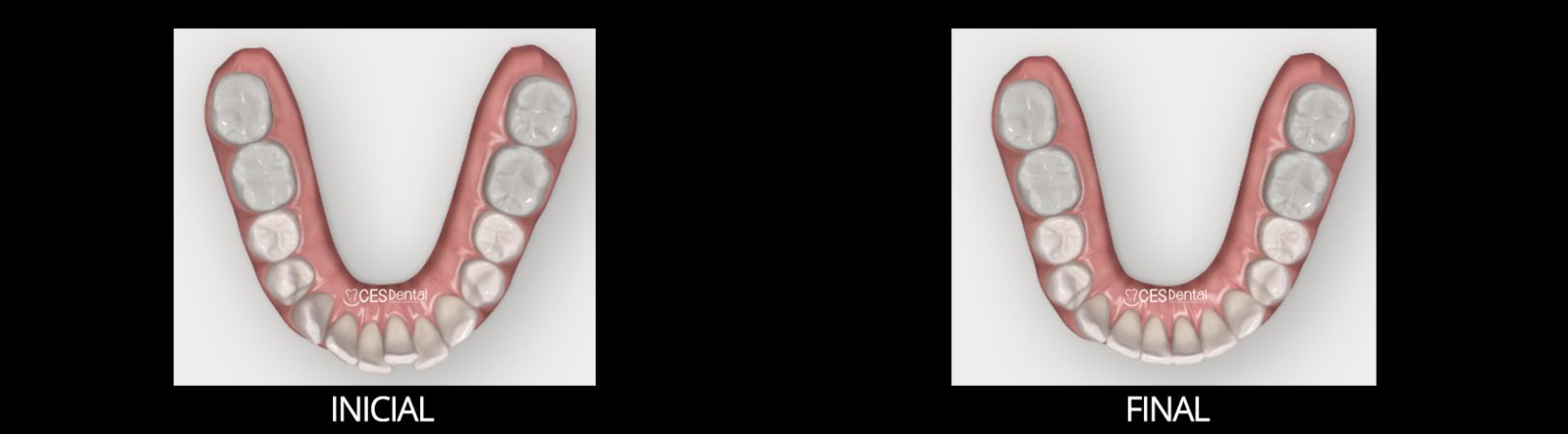 Clincheck Invisalign -