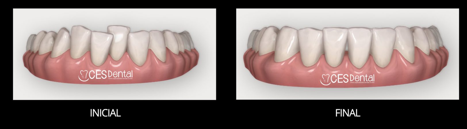 Clincheck Invisalign - de frente