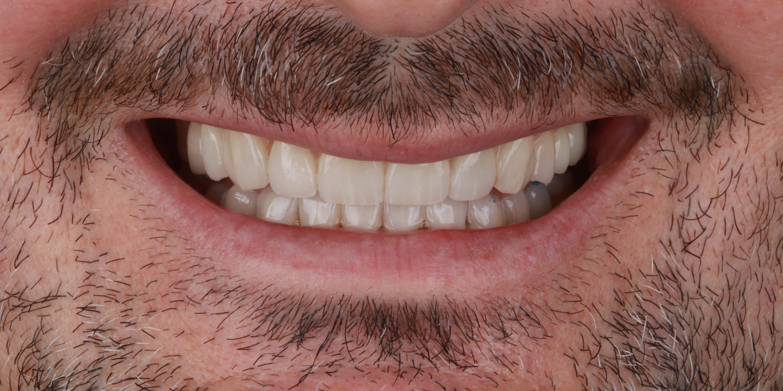 Diseño digital de sonrisa y carillas con microscopio