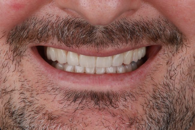 Diseño digital de sonrisa y carillas con microscopio