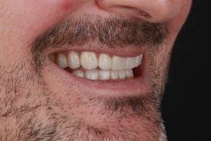 estética dental en Burjassot - perfil