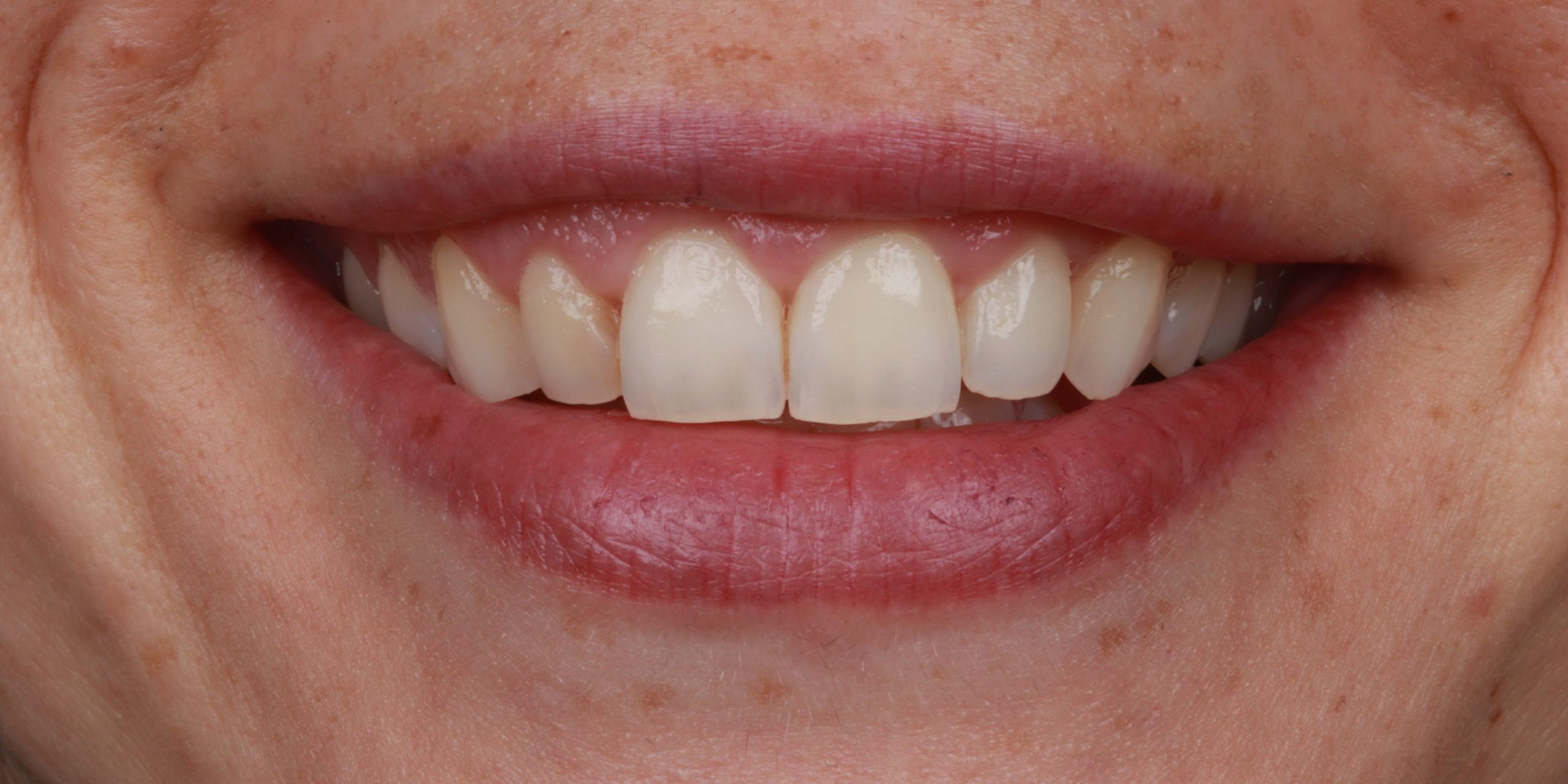 FINAL SONRISA FINAL SONRISA