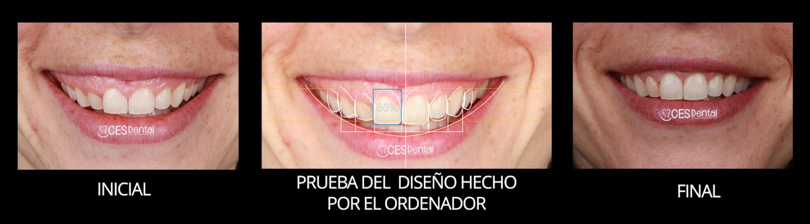 FRONTAL SONRISA