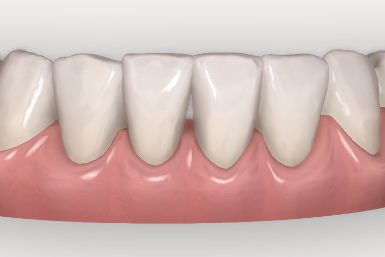 Clincheck Invisalign