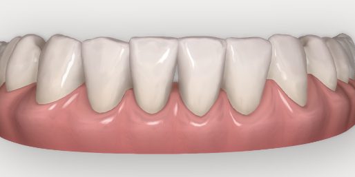 Clincheck Invisalign