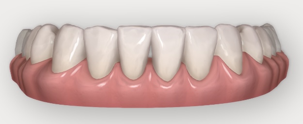 Clincheck Invisalign