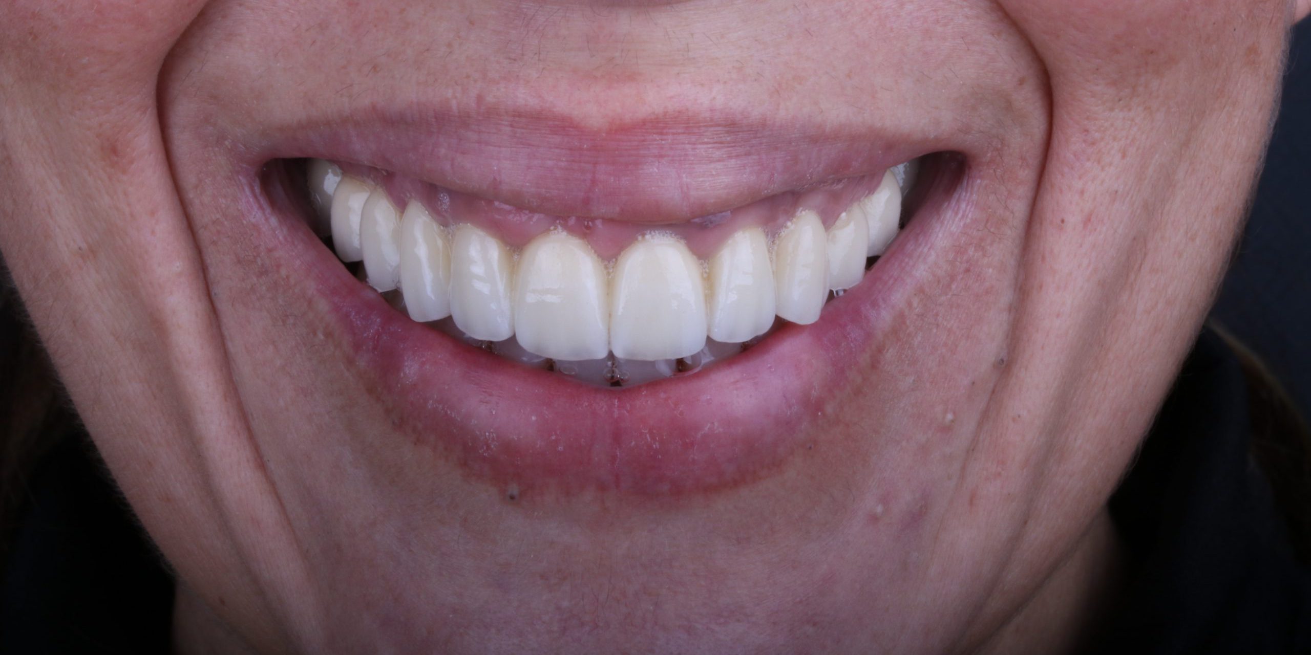 FINAL FRONTAL DETALLE