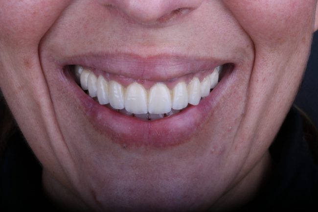 FINAL FRONTAL DETALLE