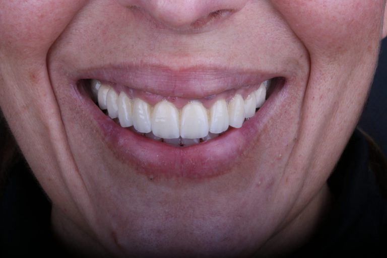 FINAL FRONTAL DETALLE