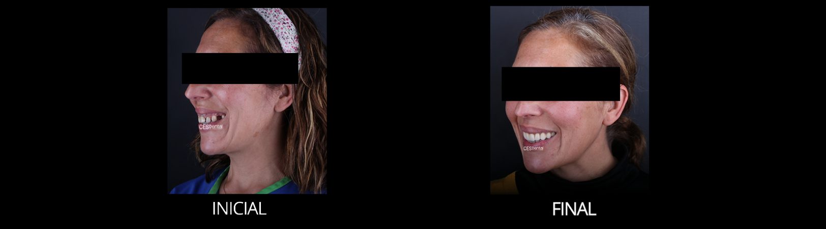 FINAL PERFIL IZQUIERDO