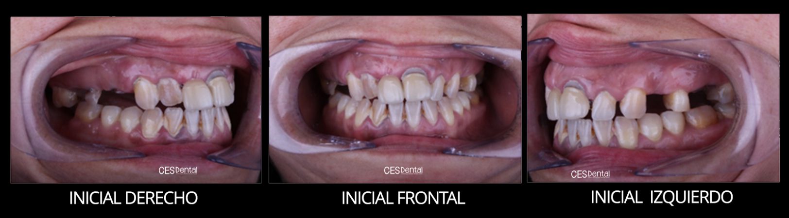 INICIALES tratamiento
