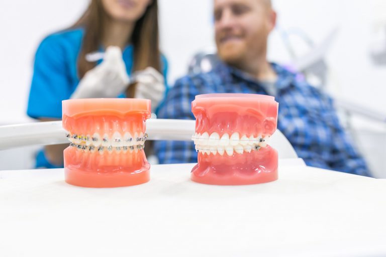 ortodoncia en Burjassot – modelos dentales