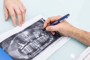 clínica dental en Burjassot - radiografía