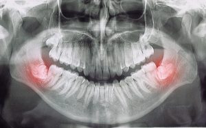 dentista en Burjassot - dolor de mandíbula