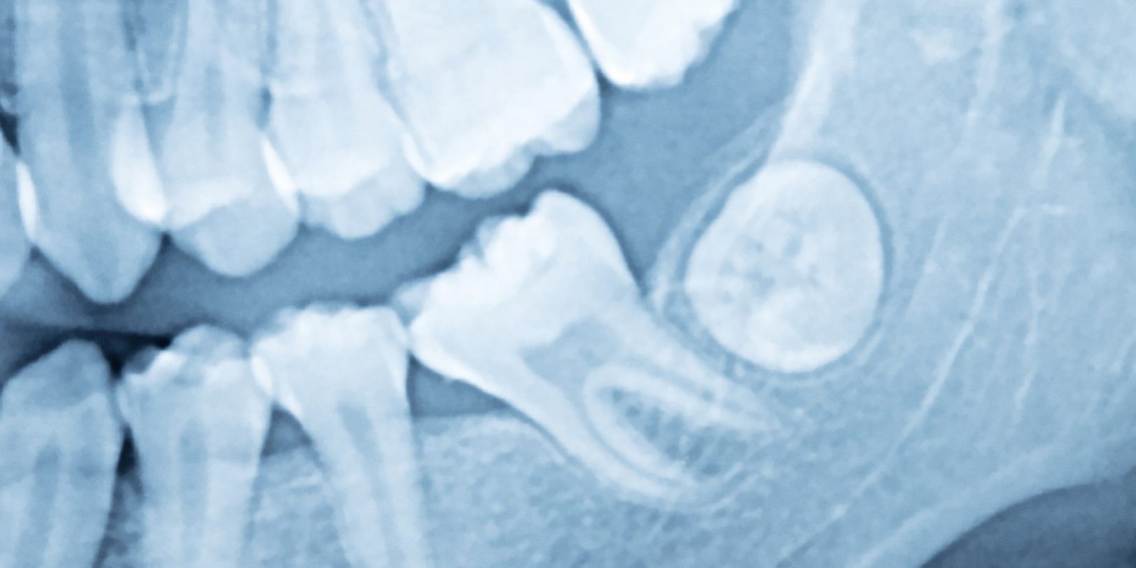 dentista en Burjassot – rayos x dentista en Burjassot - rayos x