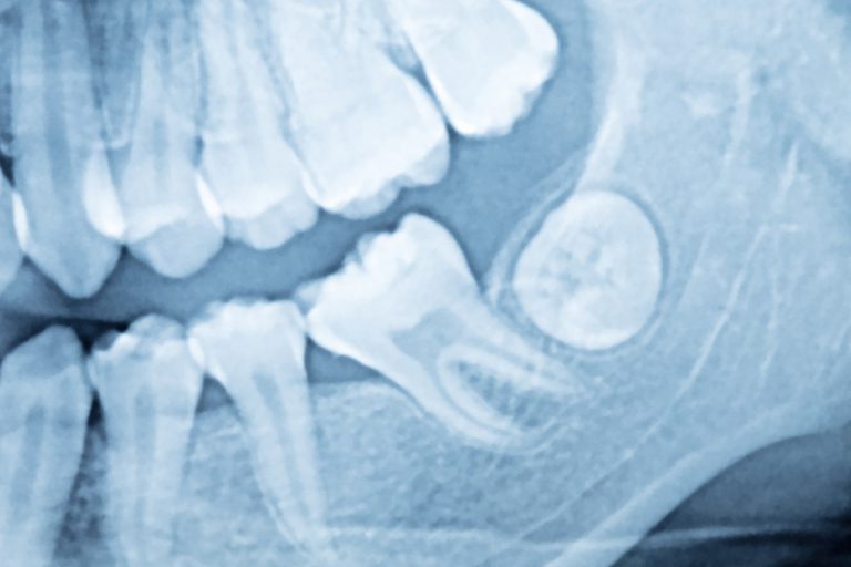 dentista en Burjassot – rayos x dentista en Burjassot - rayos x