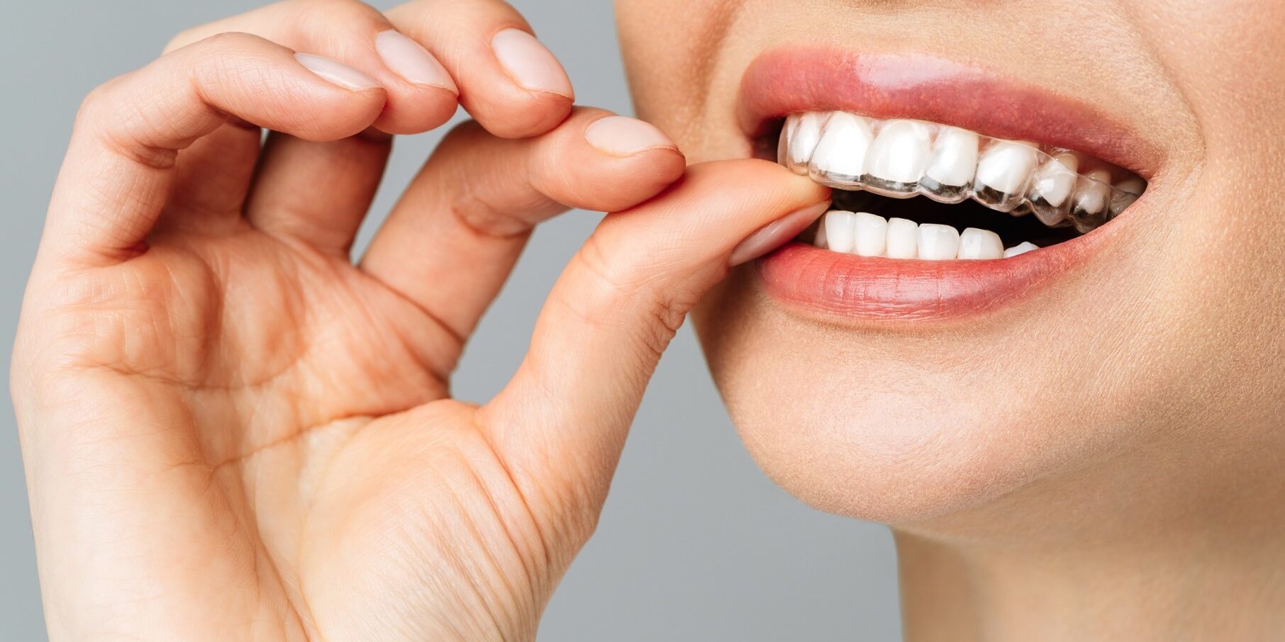 ortodoncia invisible en Burjassot - dientes alineados