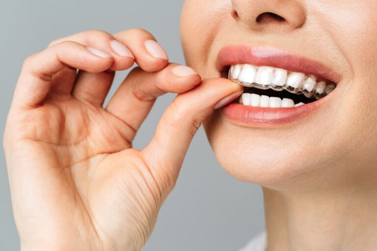 ortodoncia invisible en Burjassot – dientes alineados ortodoncia invisible en Burjassot - dientes alineados