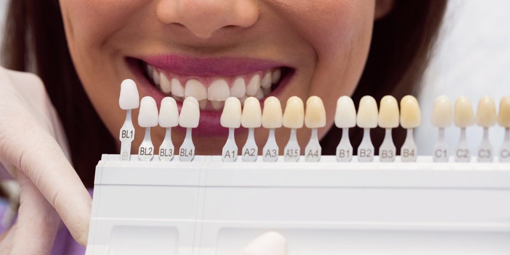 implantes con carga inmediata en Valencia - comparación