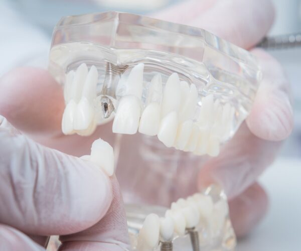 implantes con carga inmediata en Valencia - diente