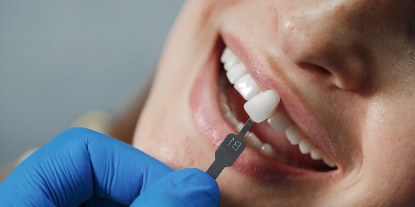 implantes con carga inmediata en Valencia – piezas dentales implantes con carga inmediata en Valencia - piezas dentales
