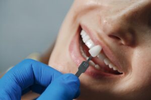 implantes con carga inmediata en Valencia - piezas dentales
