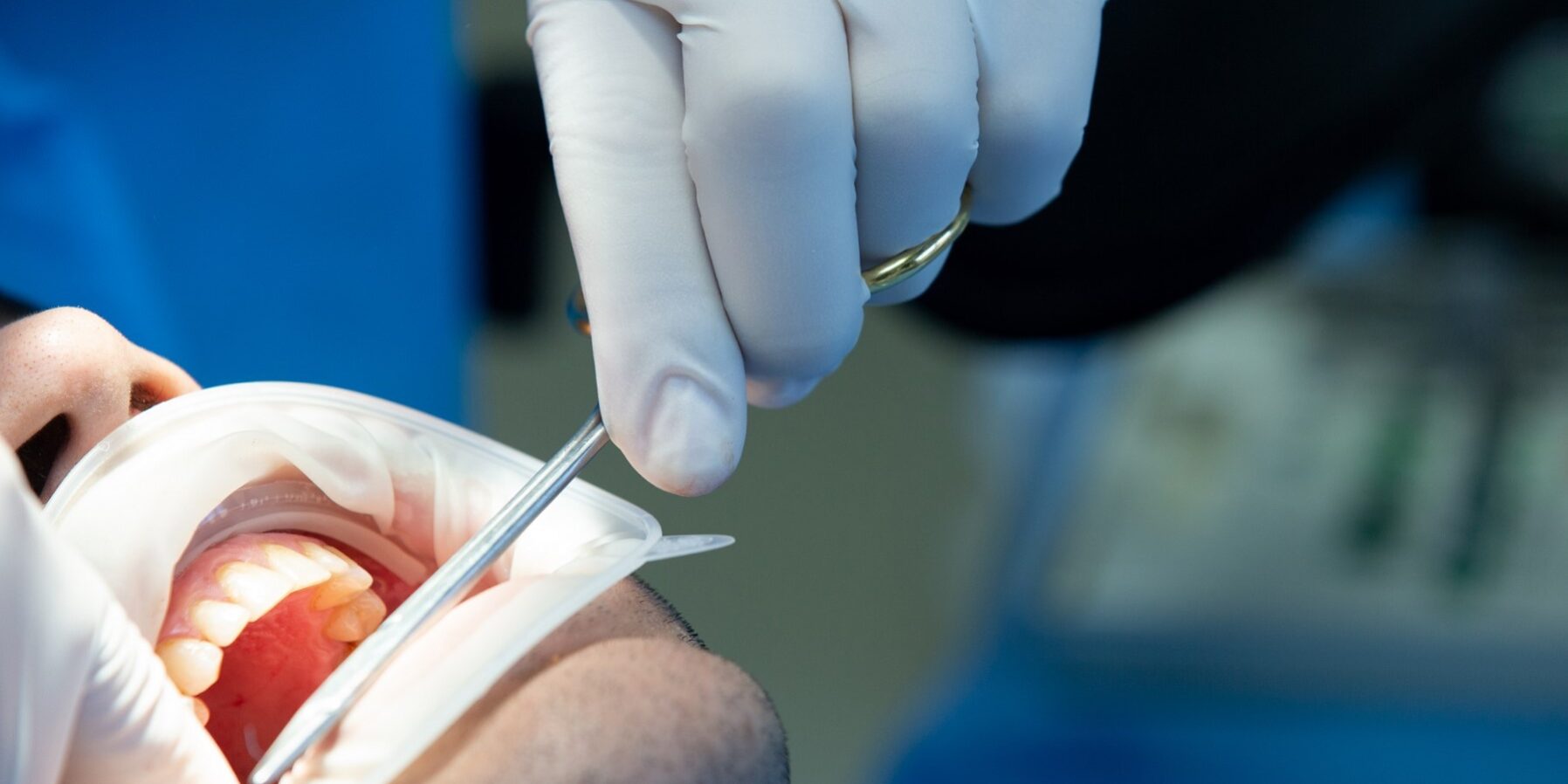 implantología inmediata en Valencia - cirugía