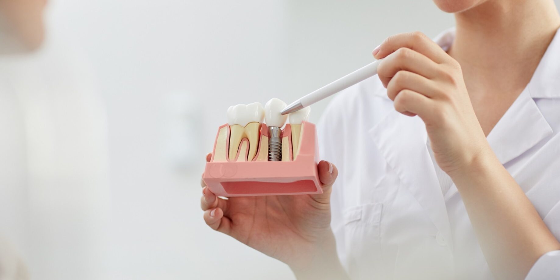 implantología inmediata en Valencia – modelo implantología inmediata en Valencia - modelo