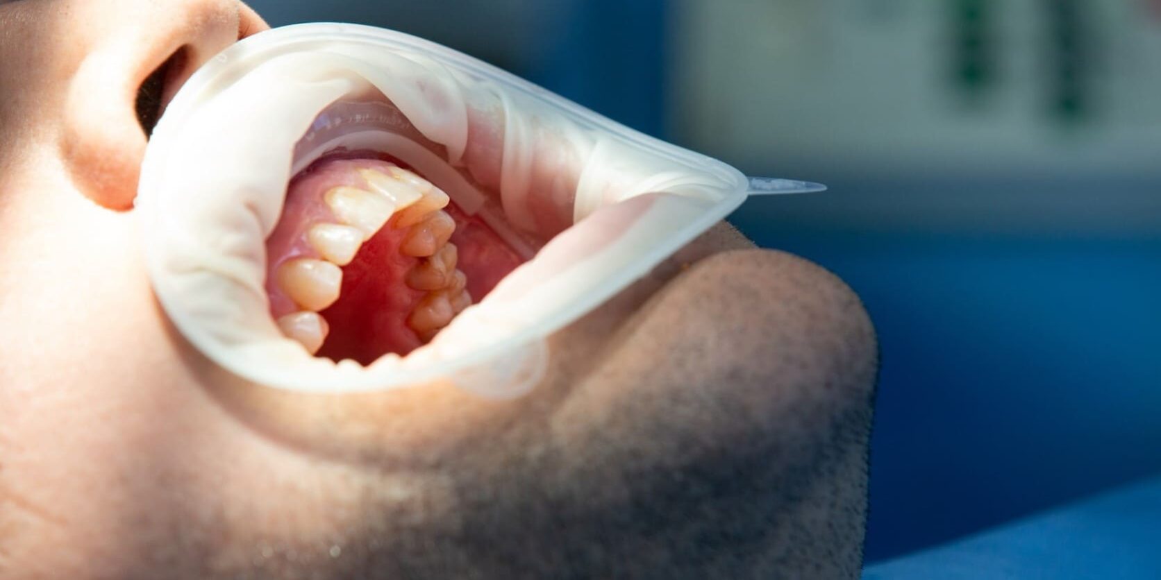 implantología inmediata en Valencia – operaciones implantología inmediata en Valencia - operaciones