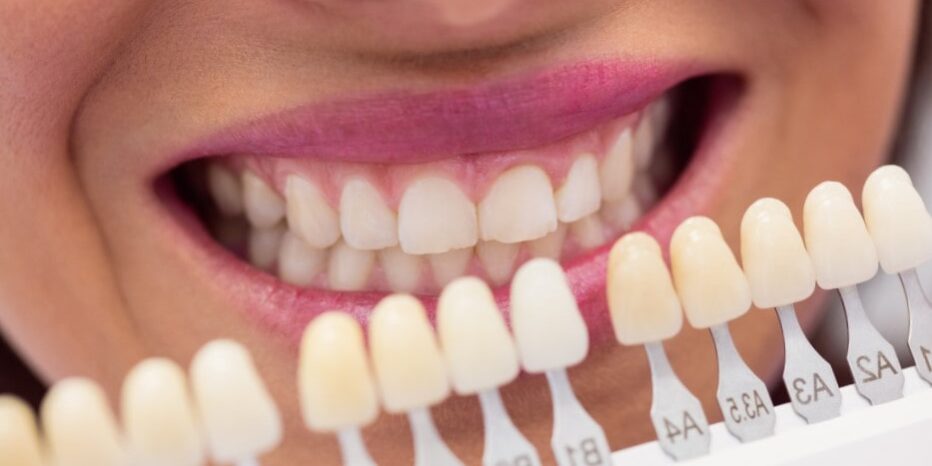 Implante de carga inmediata Valencia – Dientes Implante de carga inmediata Valencia - Dientes