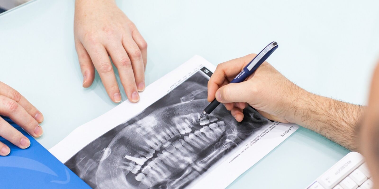 implantes fijos en Valencia – protesis 3d implantes fijos en Valencia - protesis 3d