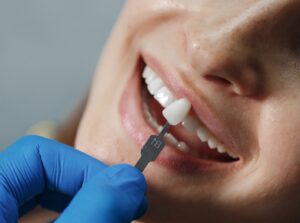 implante dental inmediato en Valencia - carilla