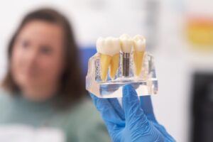 implante dental inmediato en Valencia - modelo